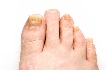 Fungal toenails treatment in the Boca Raton, FL 33431 area