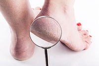 Can Vitamin Deficiencies Cause Cracked Heels?