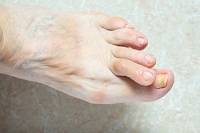 Causes of Overlapping Toes